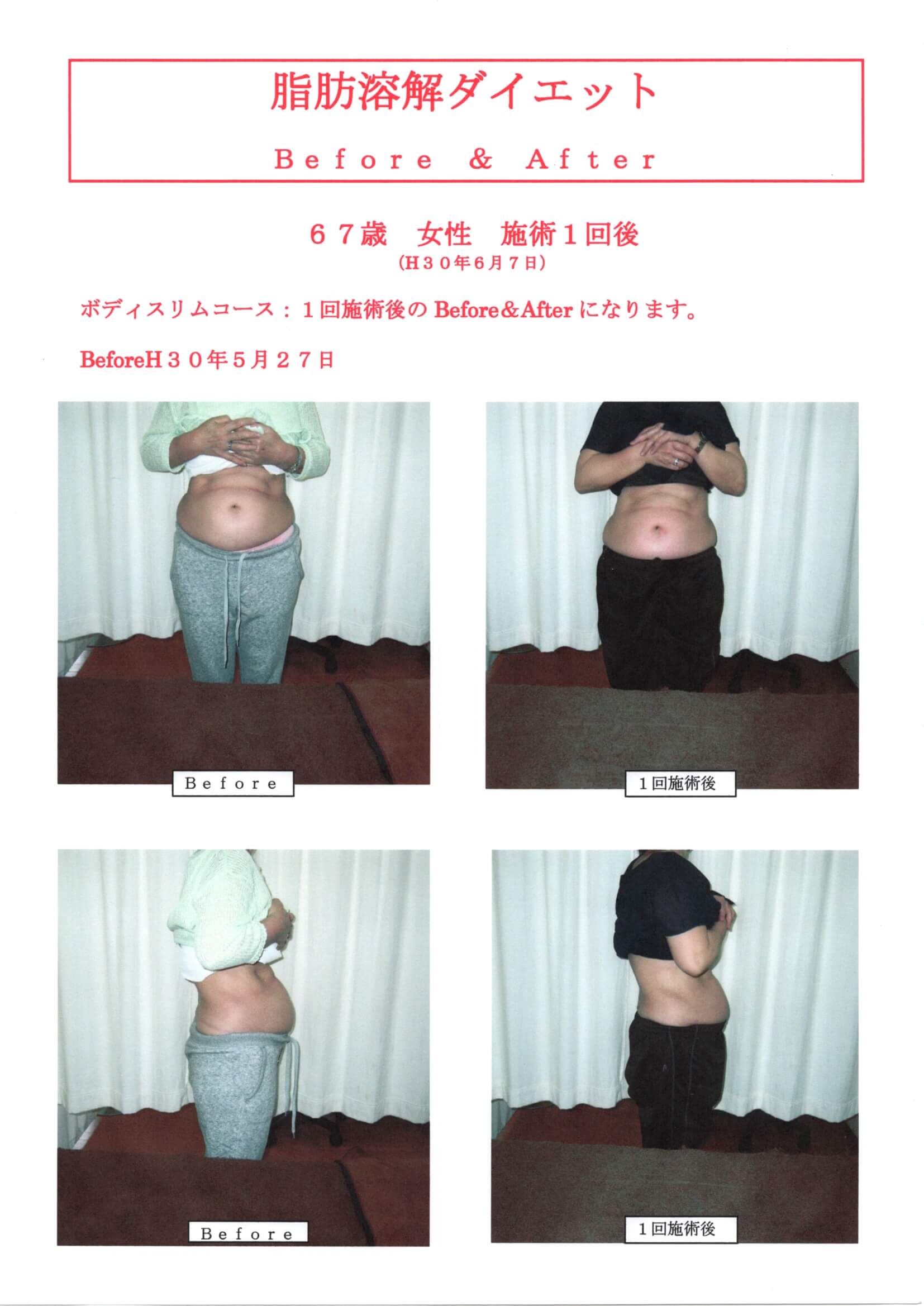 高知で人気 脂肪溶解ダイエット1回施術後