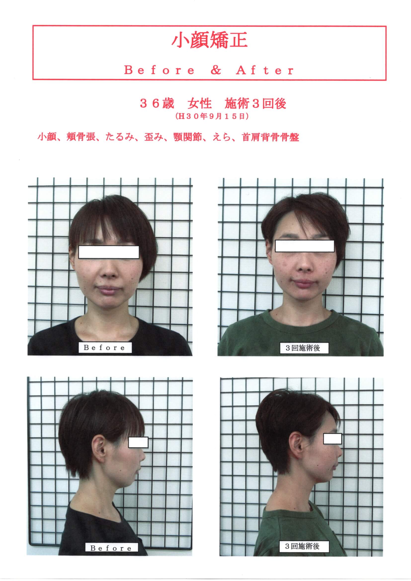 ３６歳女性3回施術後　小顔矯正