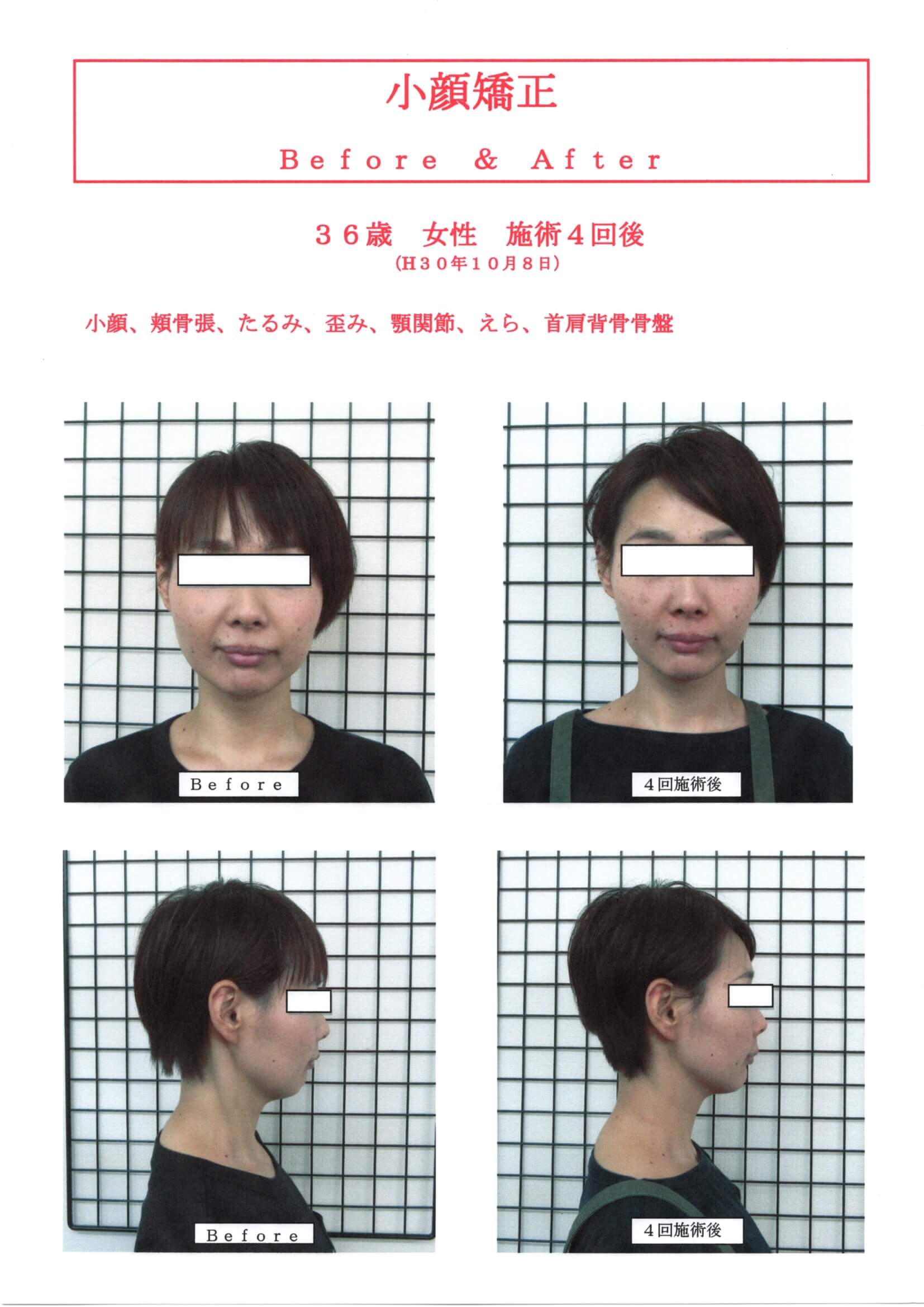 痛くないと高知で人気の小顔矯正！！