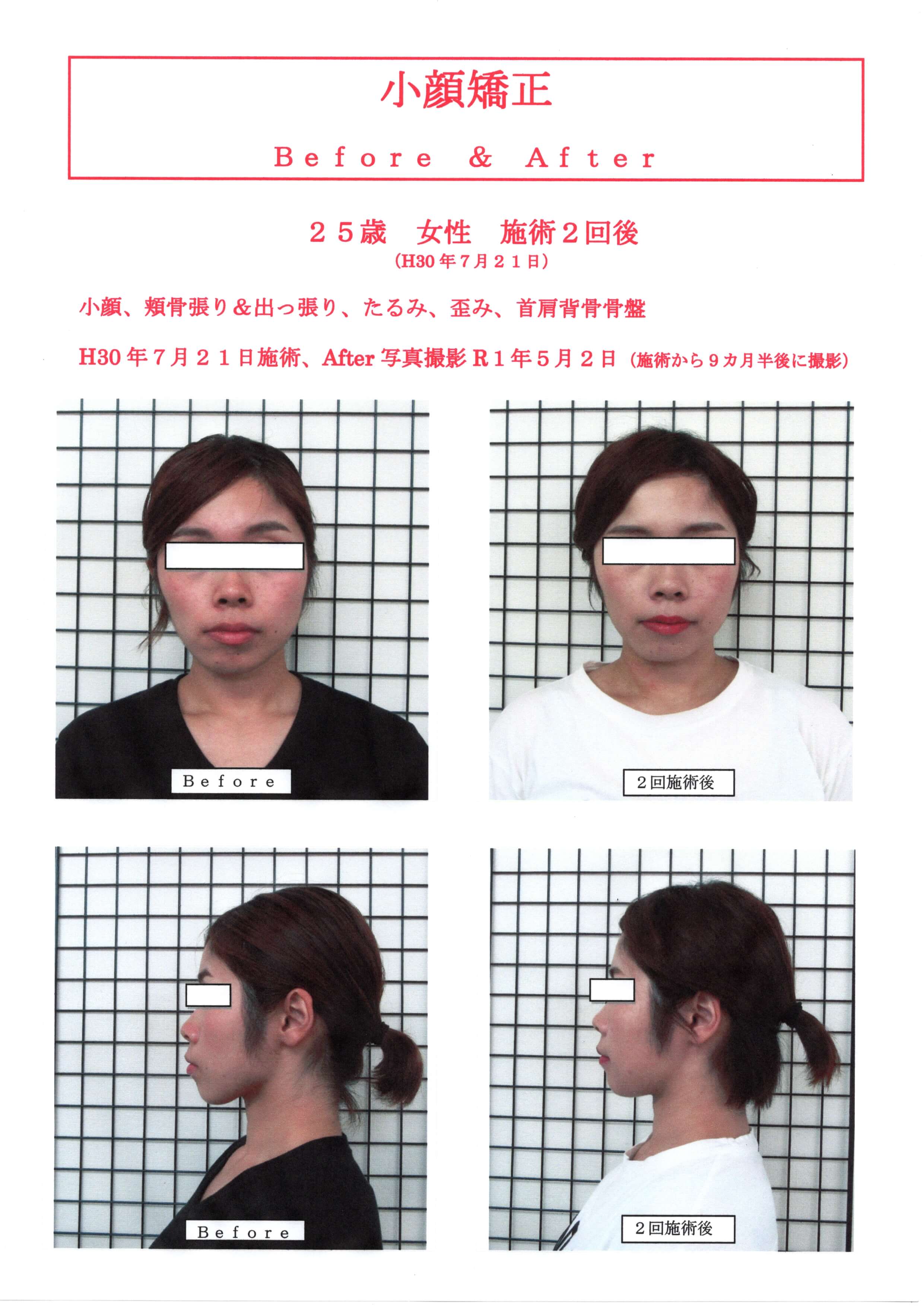 施術効果が高い小顔矯正SP!
