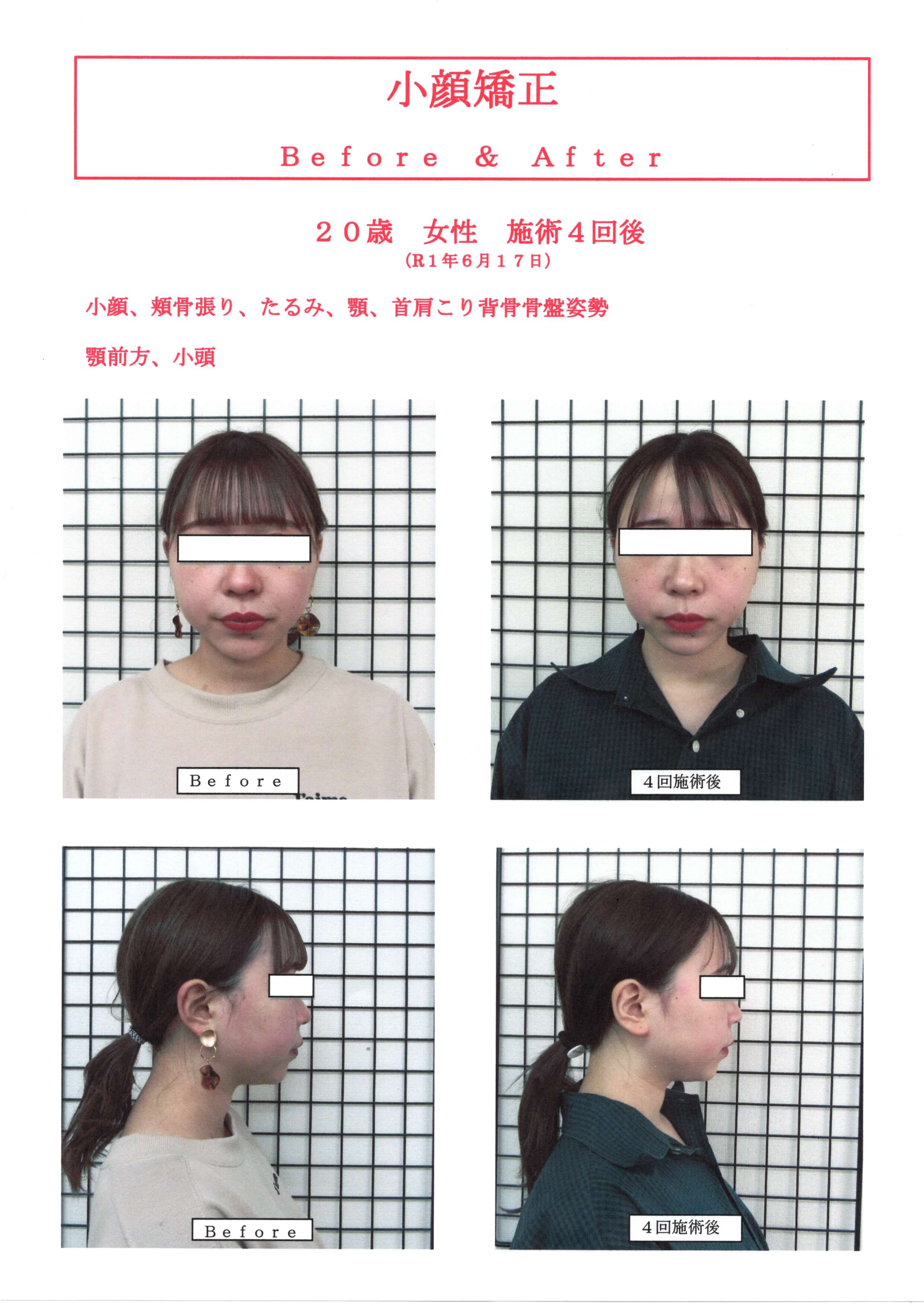 小顔矯正の効果