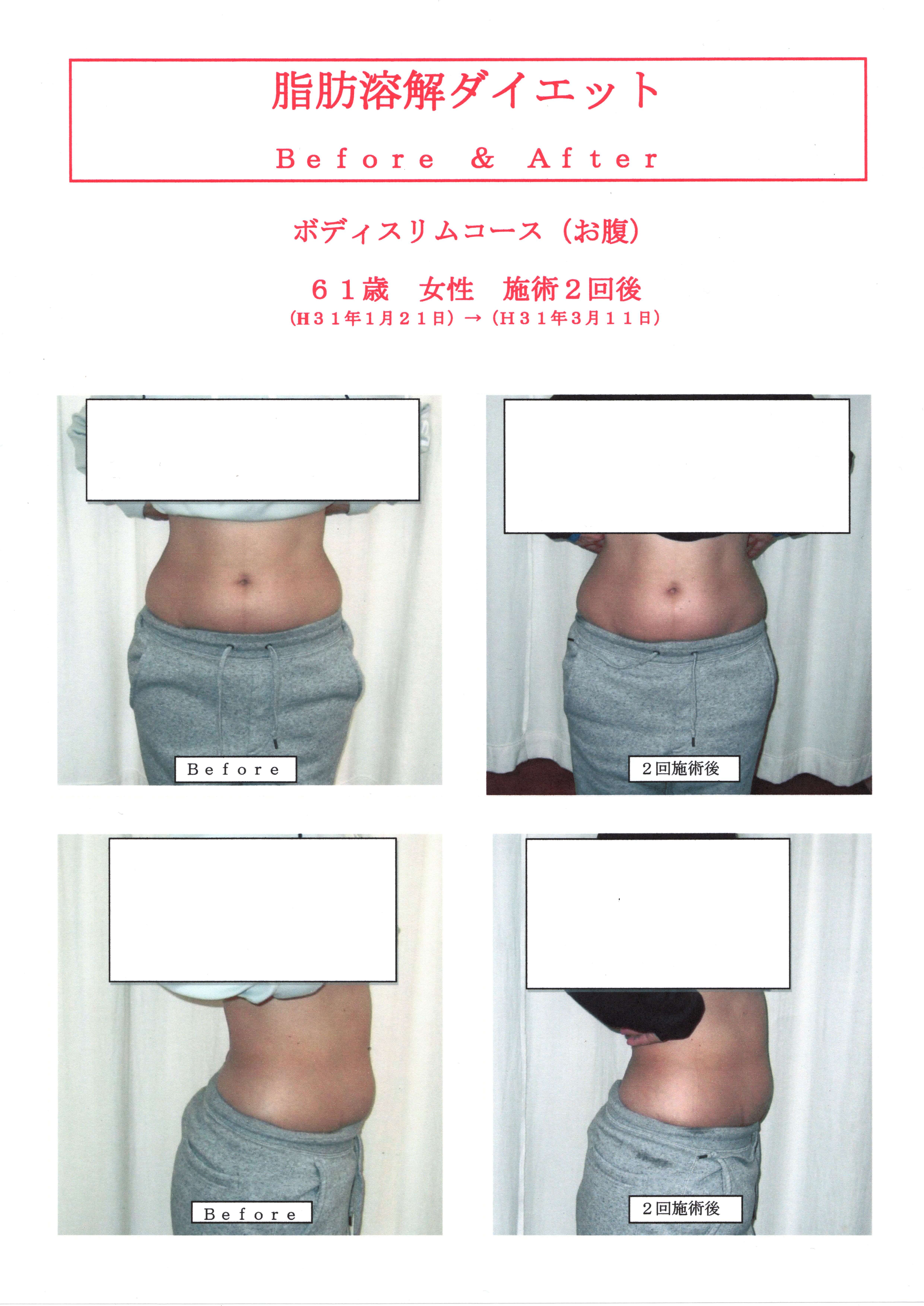 脂肪溶解ダイエット６１歳女性２回施術