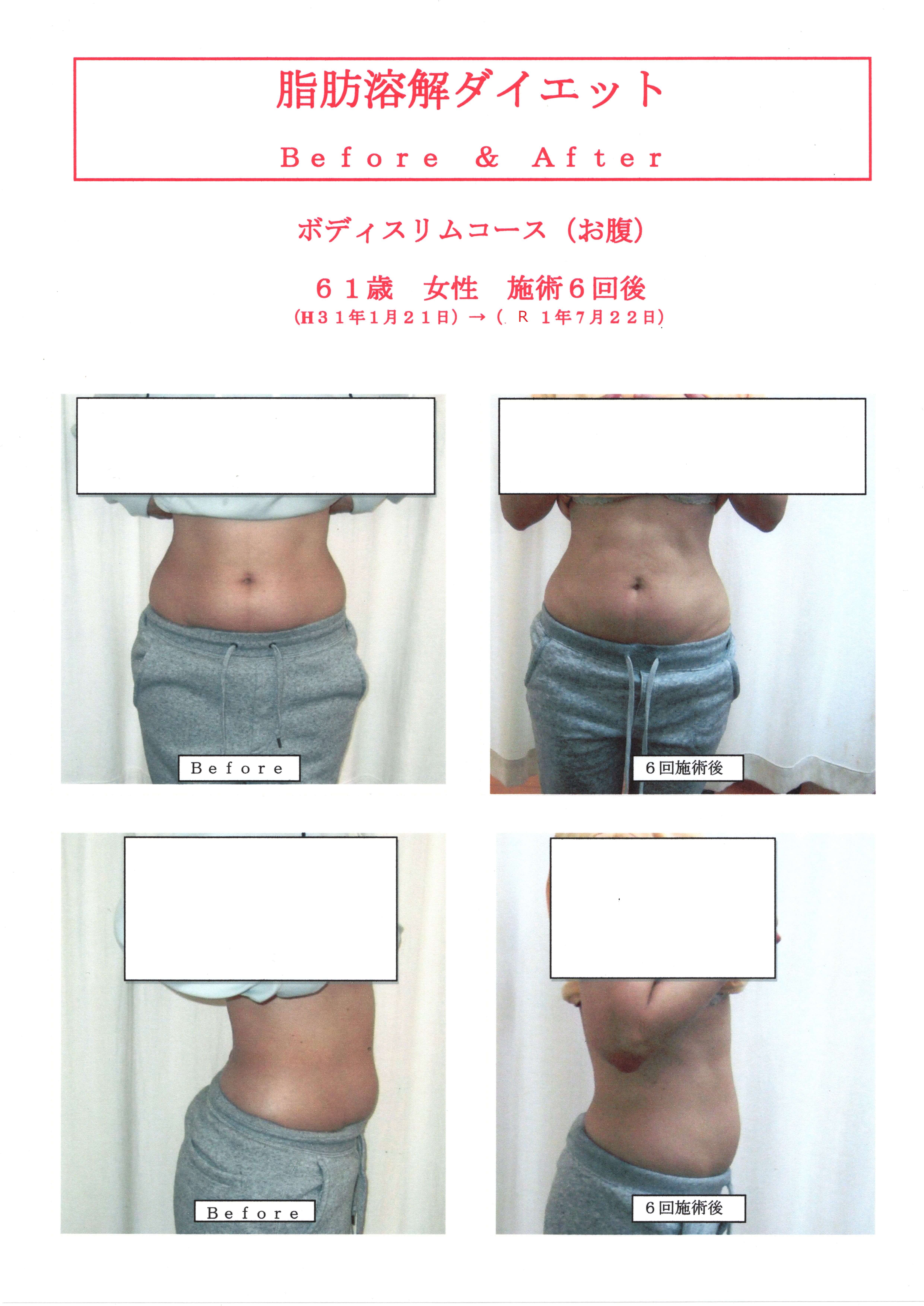 脂肪溶解ダイエット６１歳女性６回施術