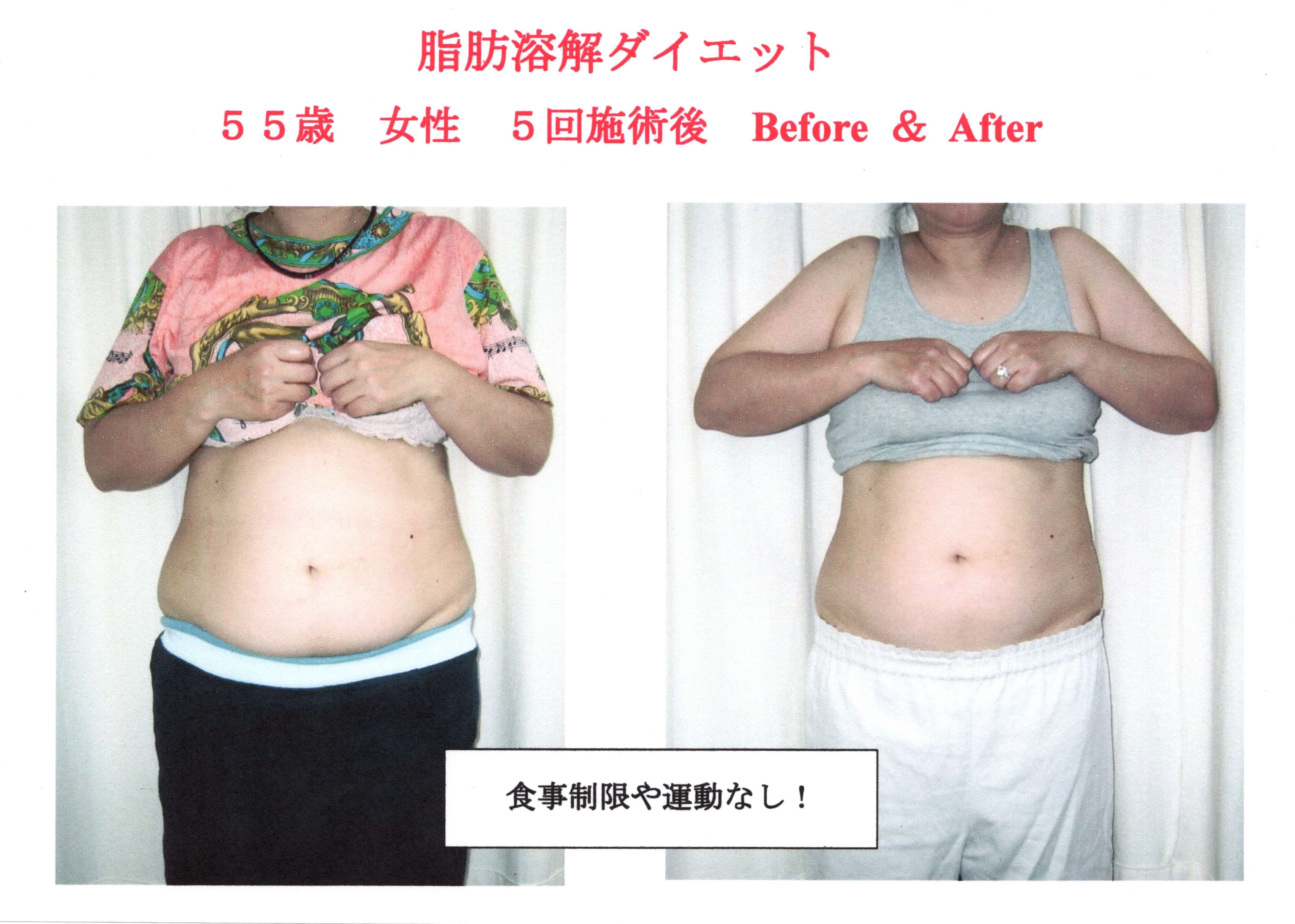 中高年の肥満と女性ホルモン