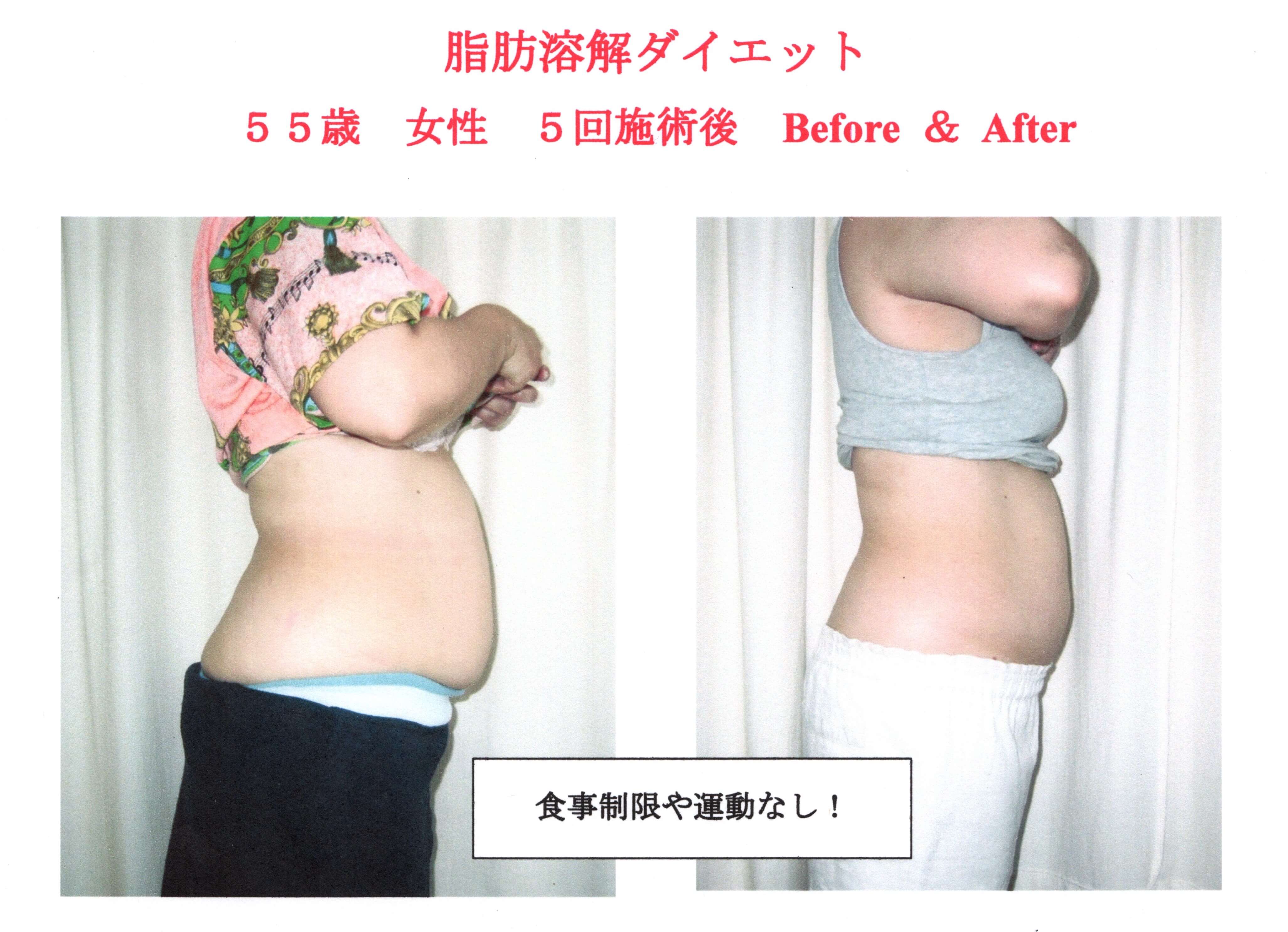 脂肪溶解ダイエットの注意点