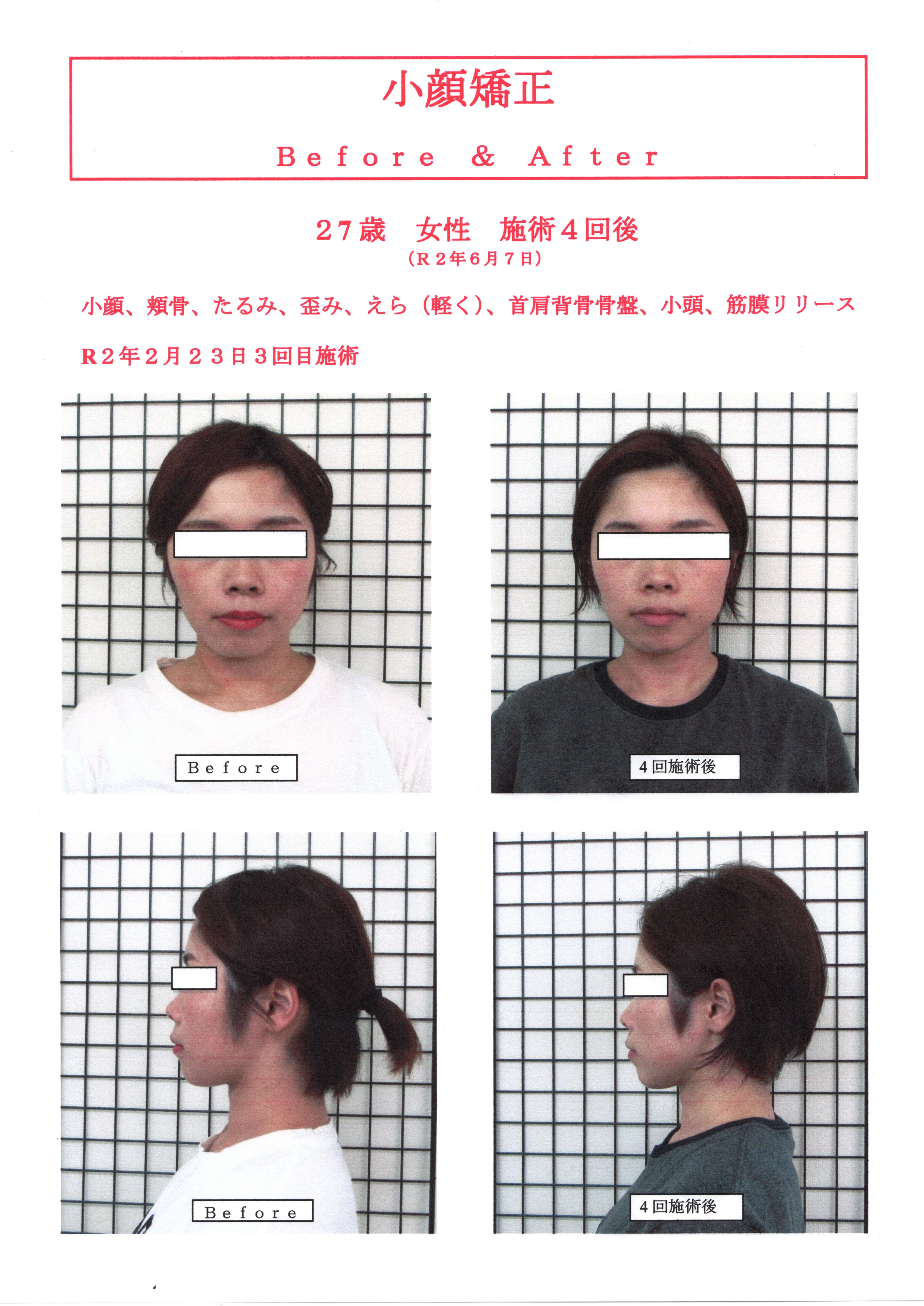 小顔矯正の施術内容の変更