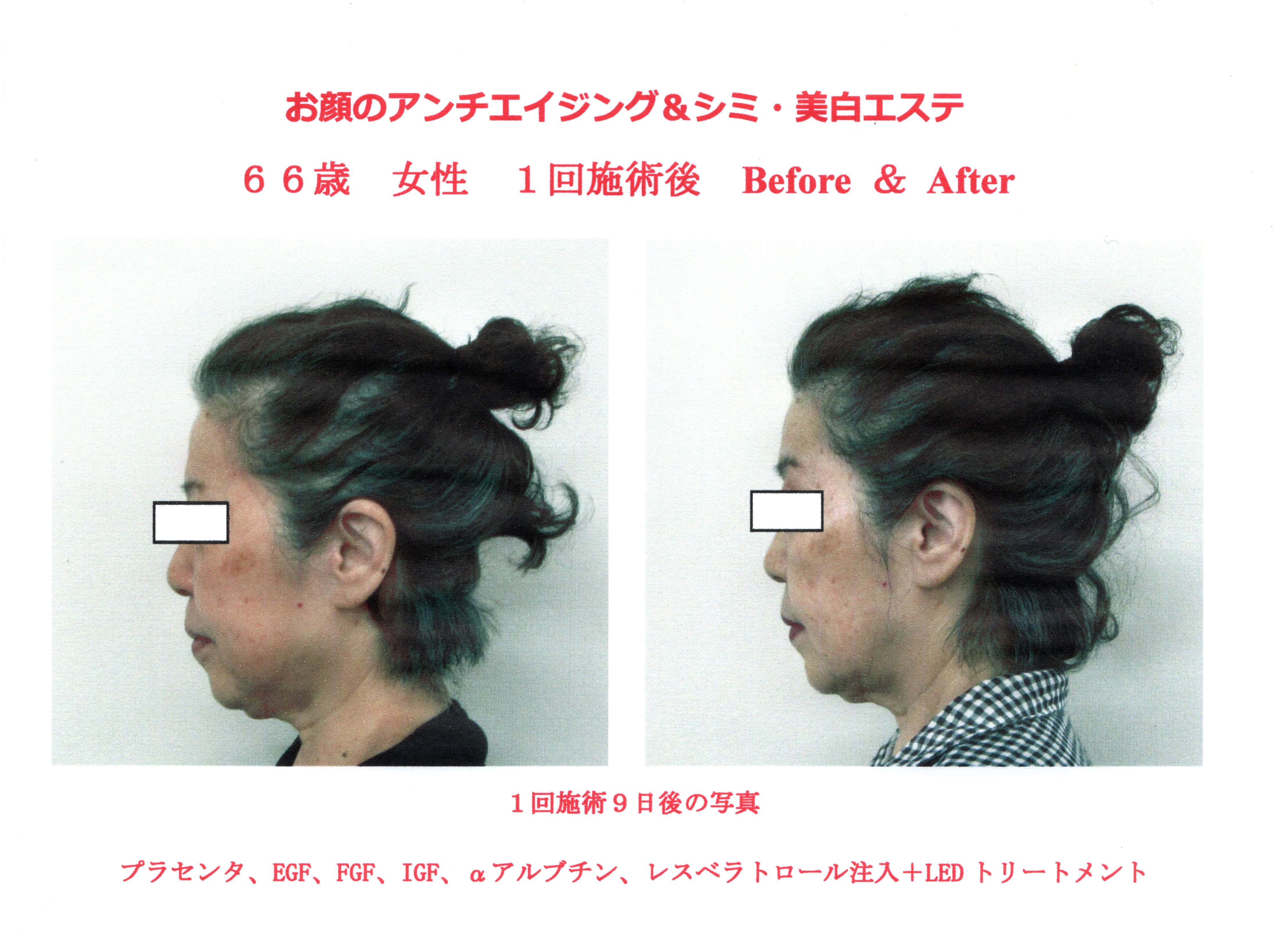 お顔のアンチエイジング&シミ・美白エステ!