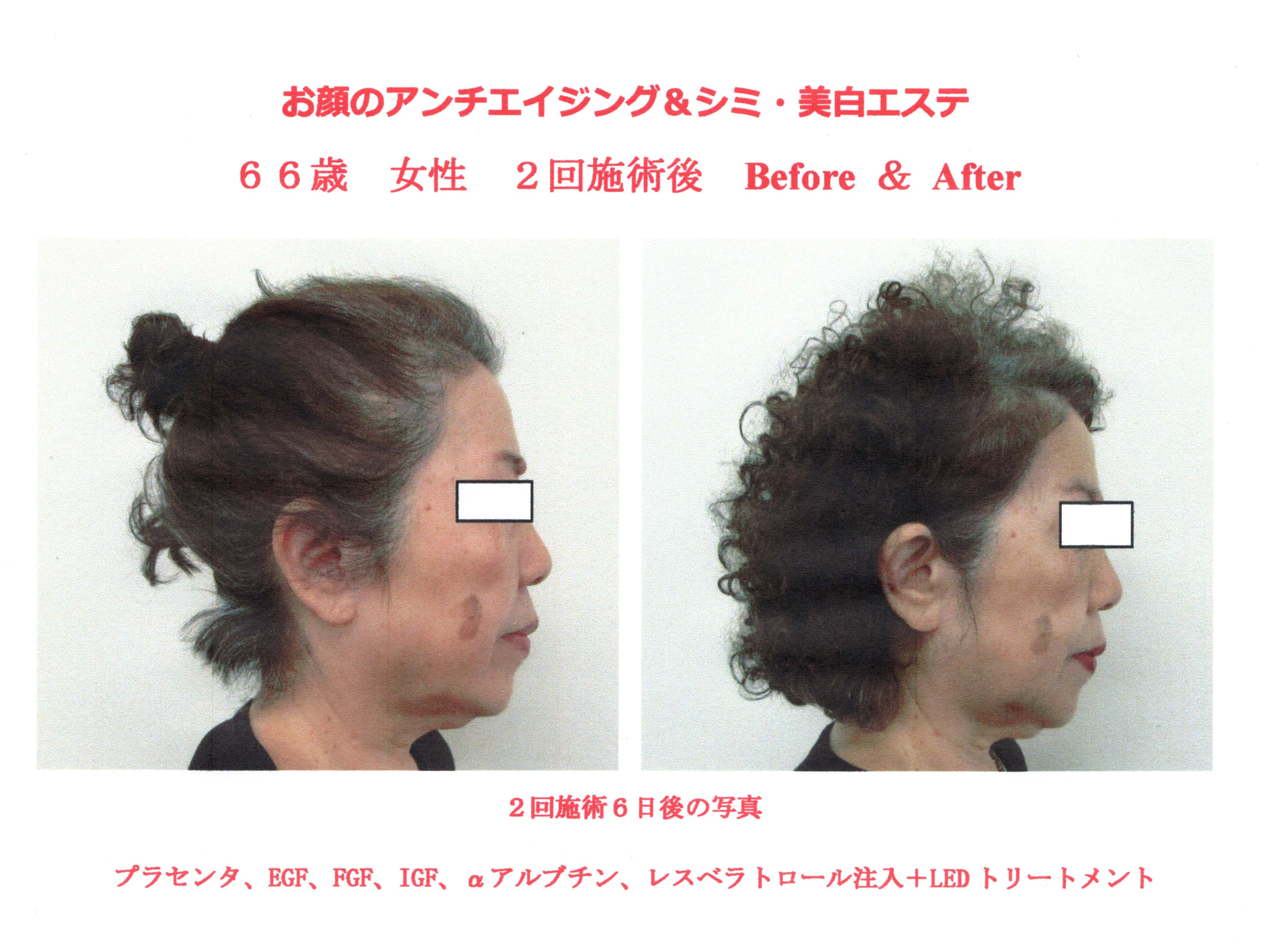 お顔のアンチエイジング・プラセンタ