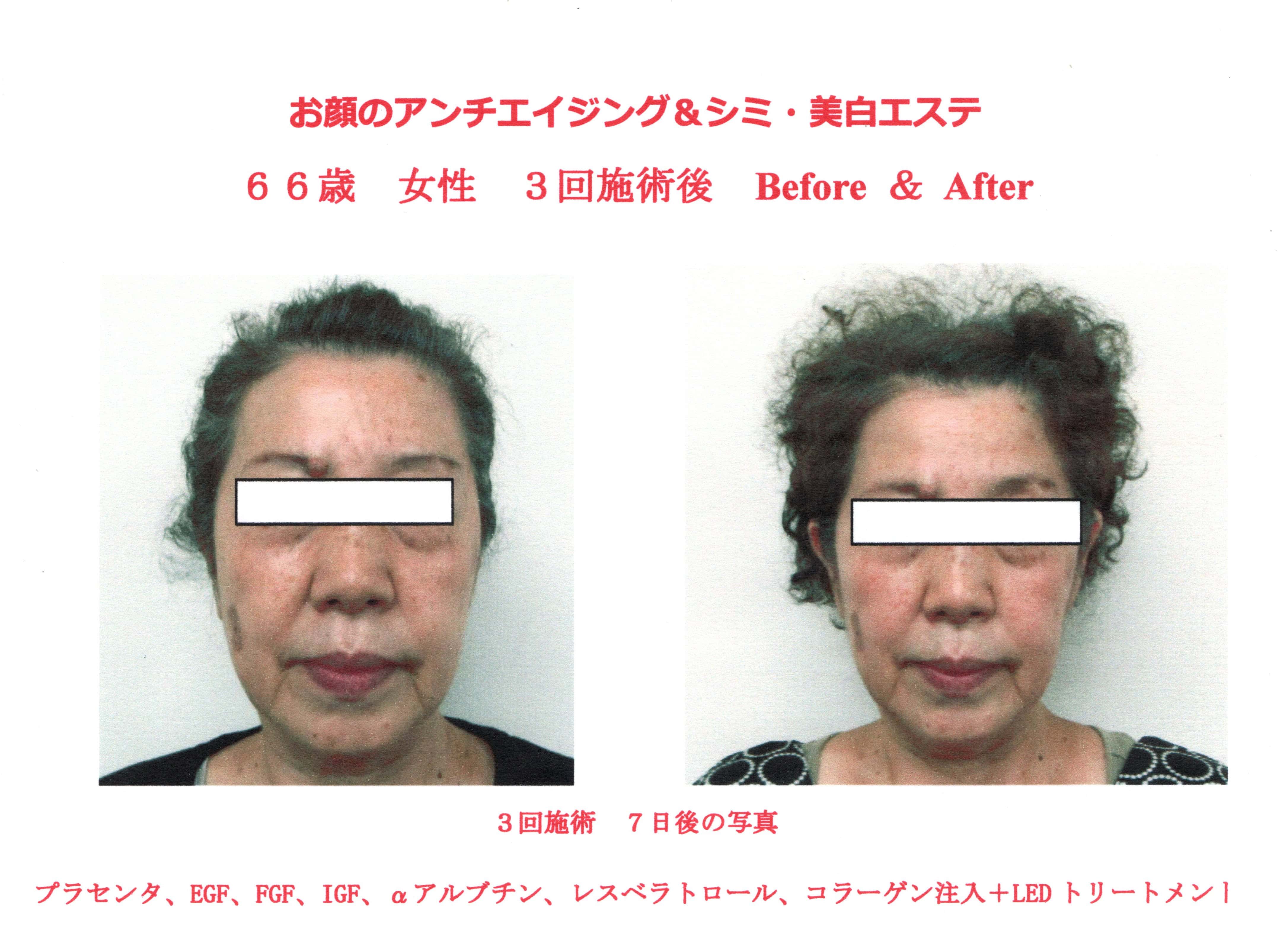 新メニュー「アンチエイジング＆シミ・美白エステ」