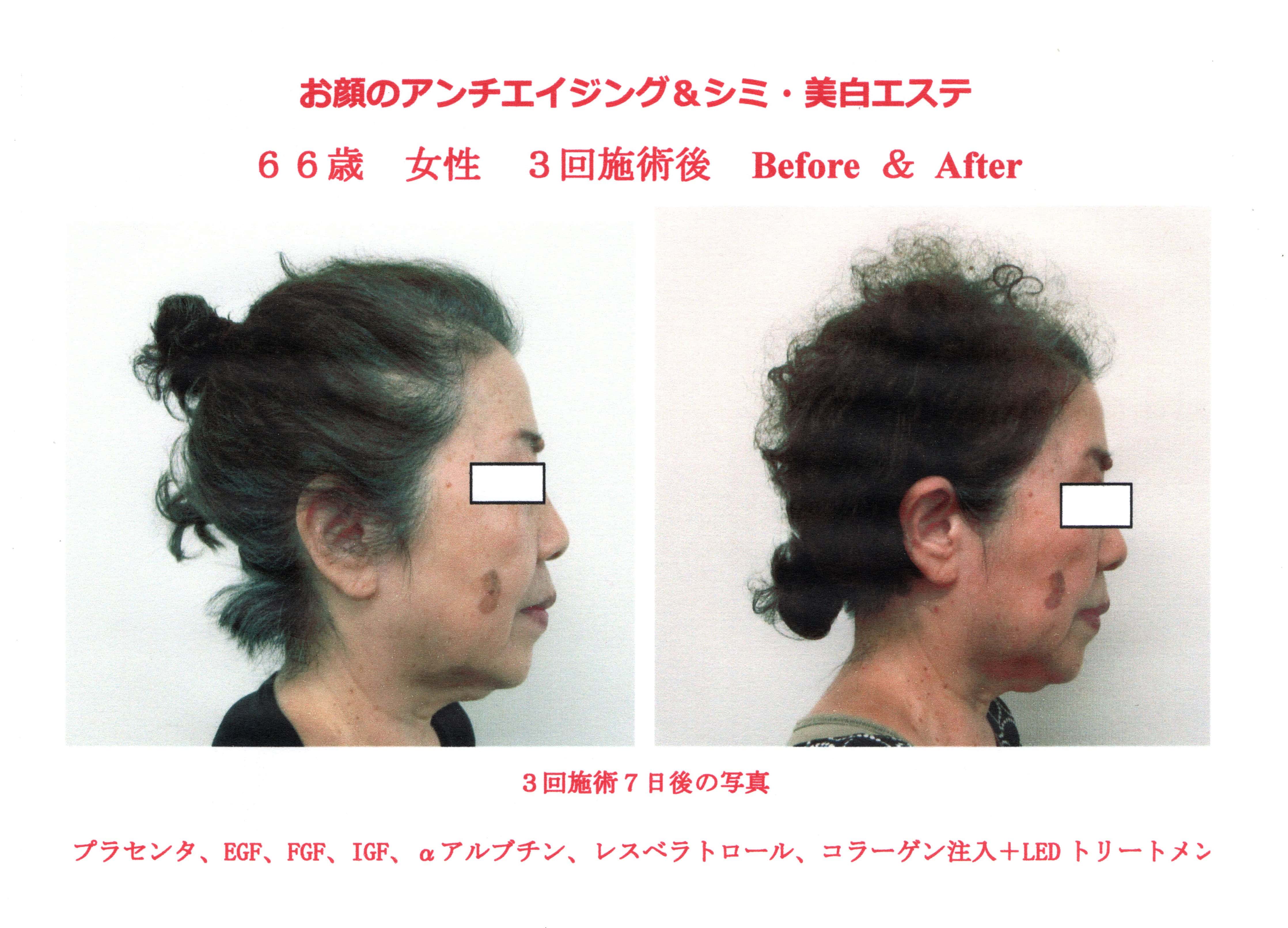 LEDトリートメントの効果