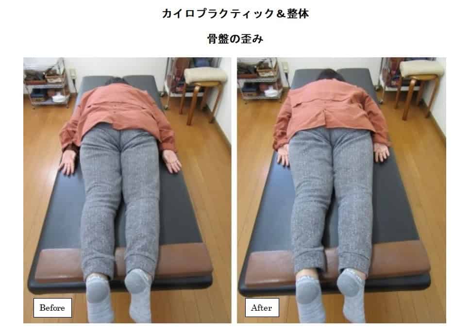 貴重 カイロプラクティック ドロップ 骨盤 腰椎 距骨 上肢下肢 整体